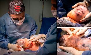 Pecah Ketuban Gagal, Bayi Lahir Terbungkus Plasenta Meski Operasi Caesar